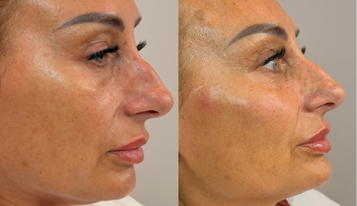 Before and after under-eye and cheek treatment result